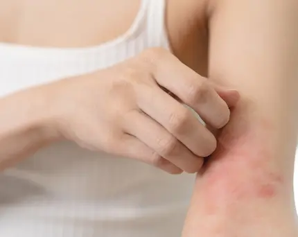 Dermatitis Atópica | Síntomas y tratamiento