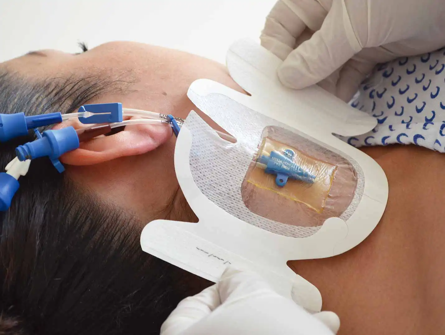 Manos de un médico con guantes blancos, colocando un apósito adhesivo sobre un catéter que está en el cuello de una paciente