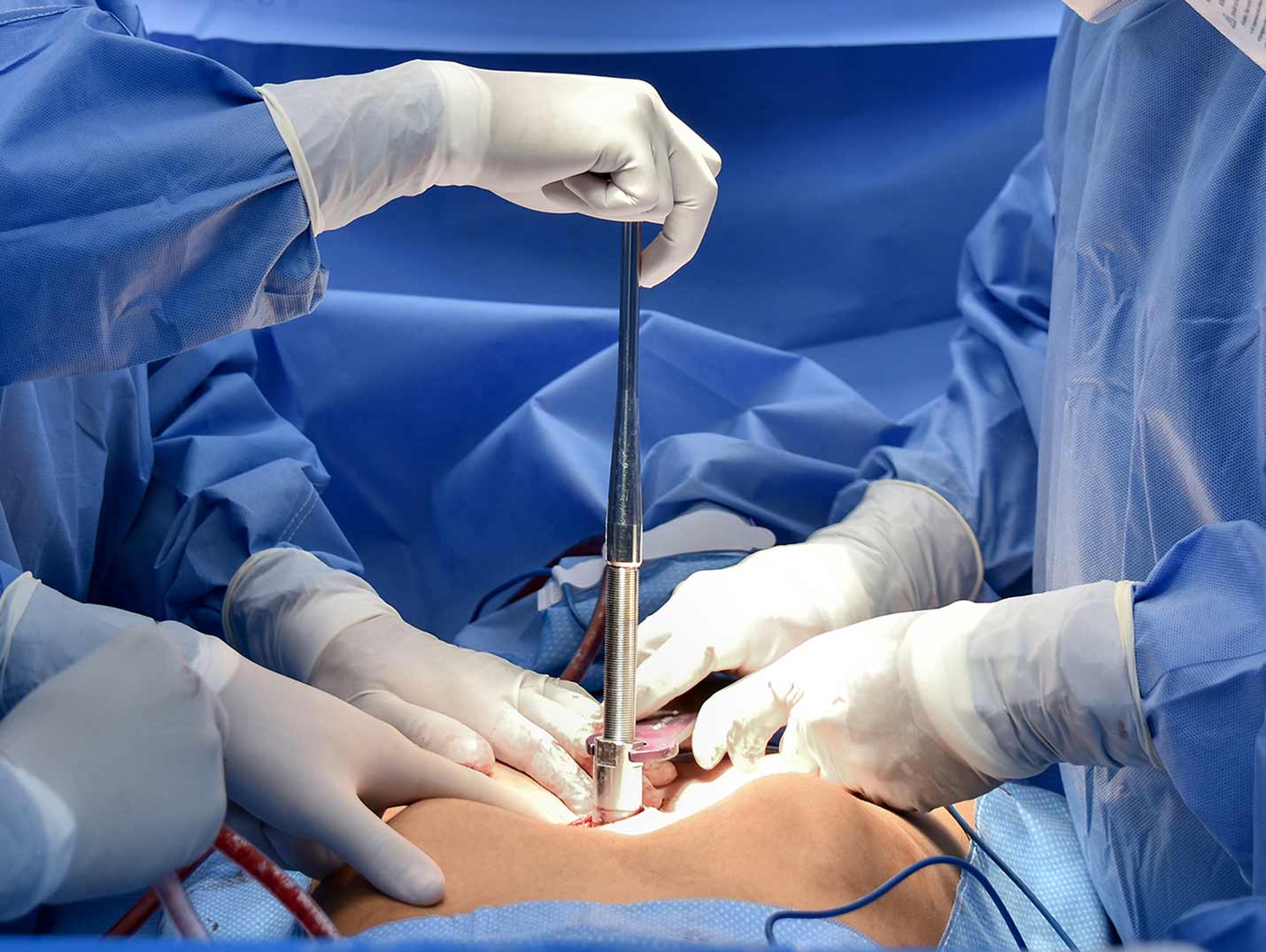 Tres médicos con pijamas azules para cirugía y guantes blancos realizando una cirugía torácica