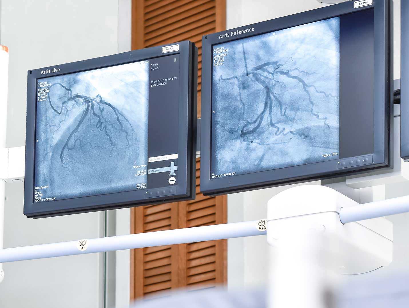 Imágenes de venas en dos monitores blancos, durante un procedimiento de hemodinamia